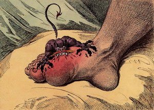 Gout Image