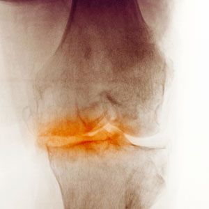 Osteoarthritis Image