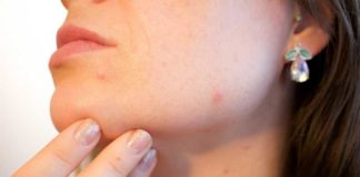 Mild-to-Moderate Acne
