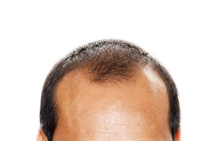 Is There a Link Between Hair Loss and Testosterone Levels? - Medical News  Bulletin