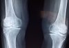 treatment for knee osteoarthritis