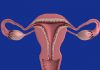 hormone-releasing intrauterine device