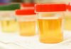 new urine test for prostate cancer