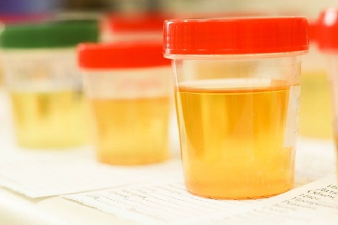 Prostate cancer urine test results
