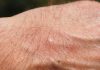 natural remedies for mosquito bites
