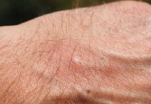 natural remedies for mosquito bites