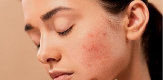 woman's face with acne