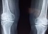 knee bone x-ray image