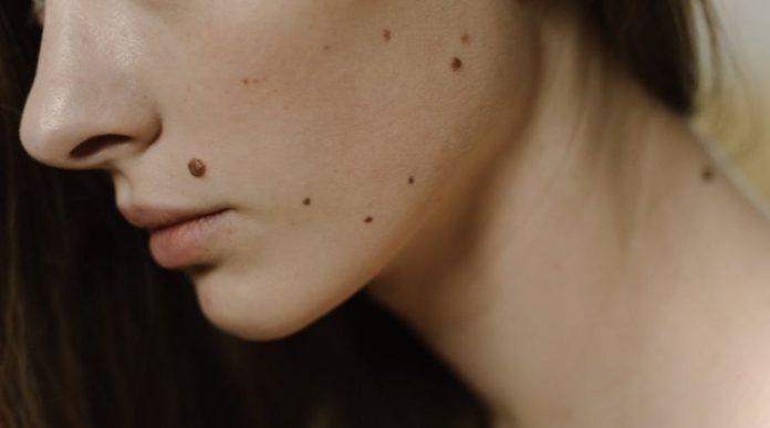 DIY Mole and Skin Tag Removal