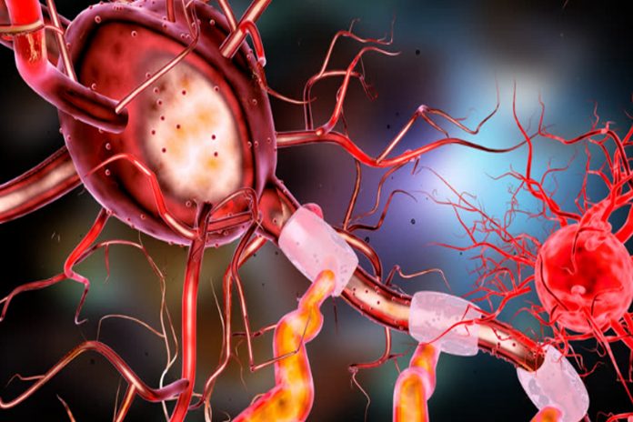 An image of a neuron. Guillain-Barre Syndrome is a rare autoimmune disorder that affects the nervous system.