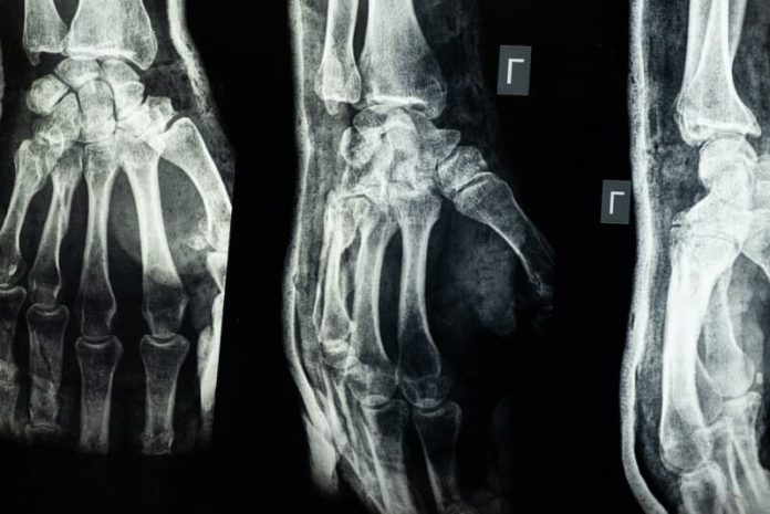Efficacy and Safety of a Bone Loss Treatment