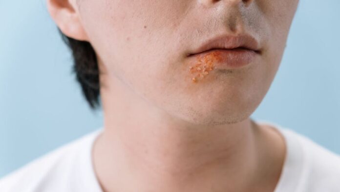 Herpes treatments that WORK - Image by cottonbro studio from Pexels
